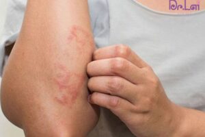 Trị viêm da cơ địa