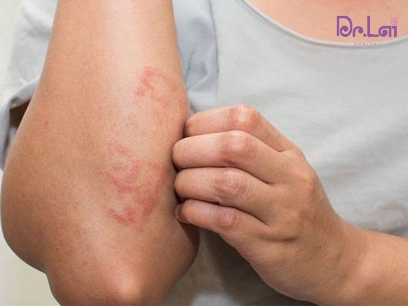 Triệu chứng nhận biết bệnh viêm da cơ địa