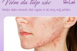 Trị viêm da tiếp xúc