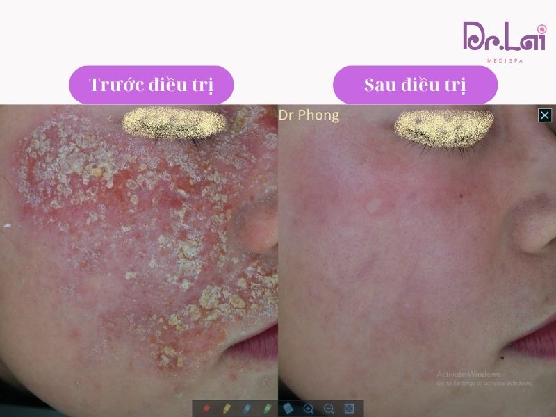 Hình ảnh thực tế khách hàng trị viêm da tiếp xúc tại Dr Lai