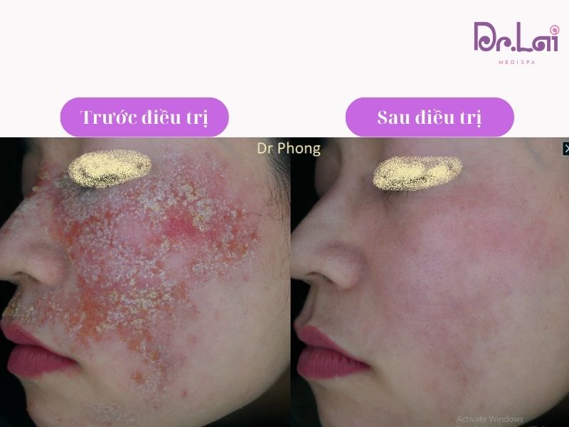 Hình ảnh thực tế khách hàng trị viêm da tiếp xúc tại Dr Lai