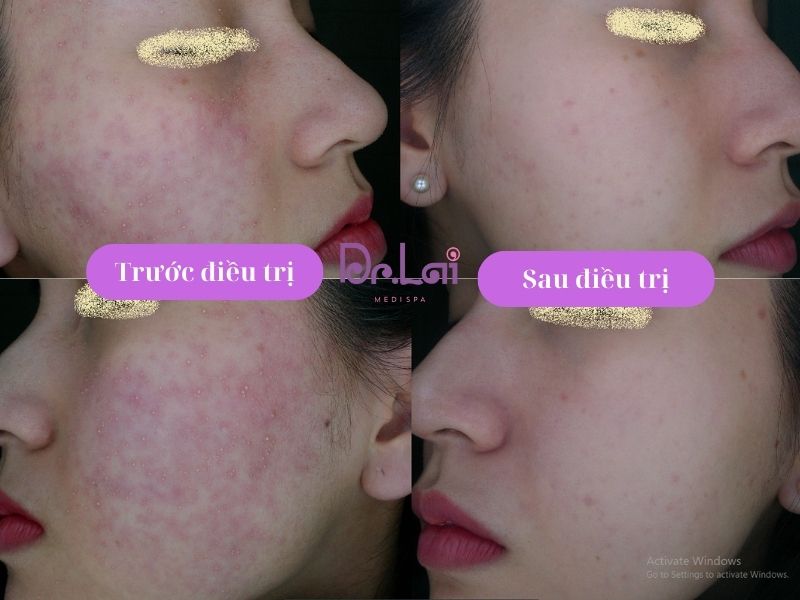 Hình ảnh thực tế khách hàng trị viêm da tiếp xúc tại Dr Lai