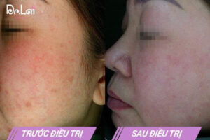 Ảnh khách hàng trước và sau khi nâng cơ tại Dr Lai