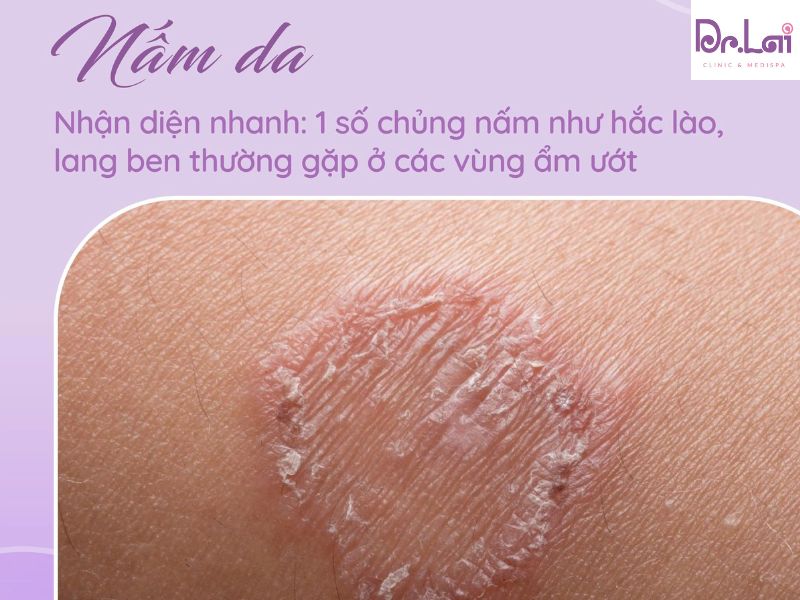 Nấm da là gì?