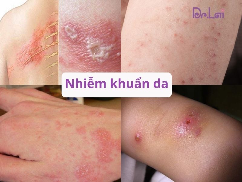 Nhiễm khuẩn da là gì?