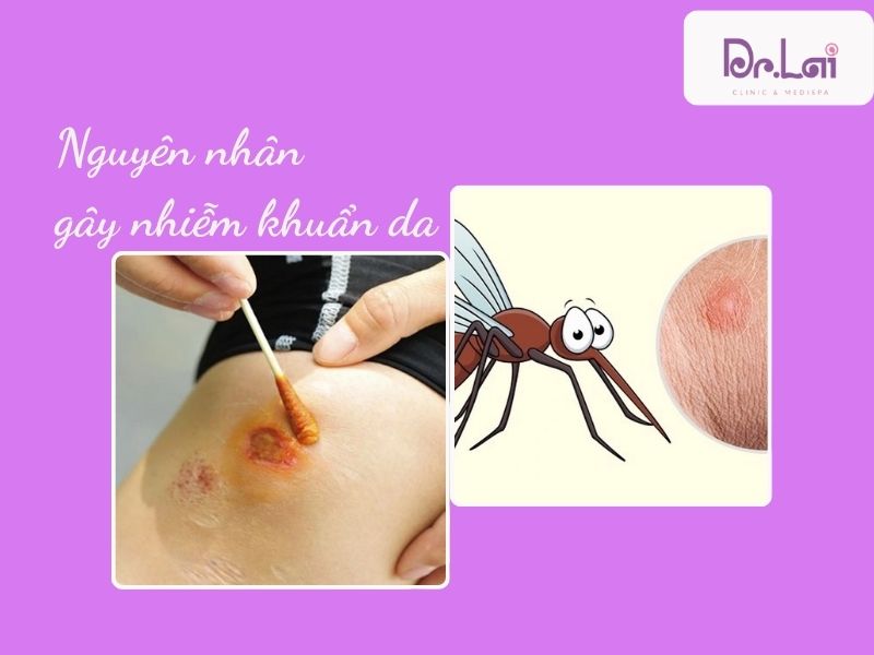 Nguyên nhân gây nhiễm khuẩn da