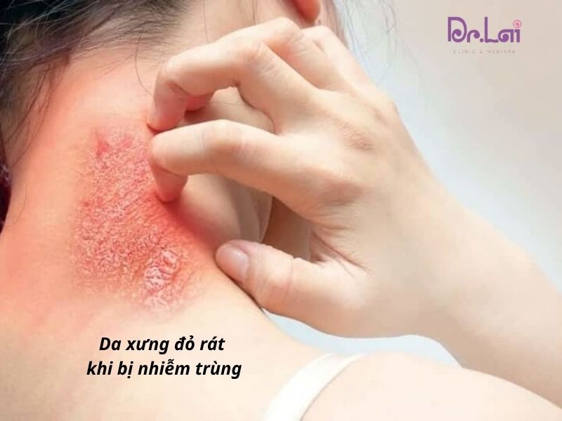Dấu hiệu nhận biết nhiễm khuẩn da
