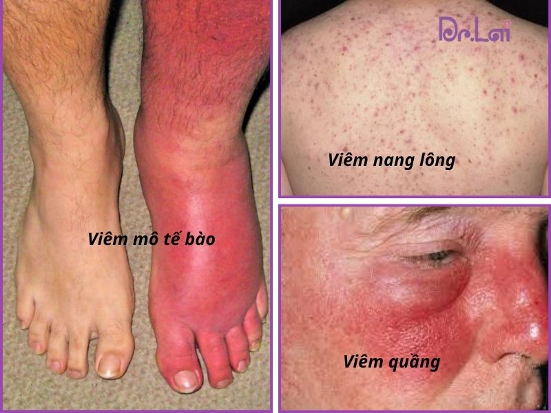 Các loại bệnh nhiễm trùng da do vi khuẩn