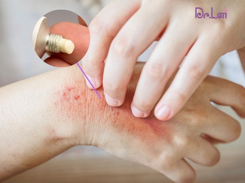 Cách phương pháp điều trị da do vi khuẩn