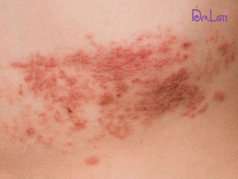 Vì sao virus gây tổn thương da?