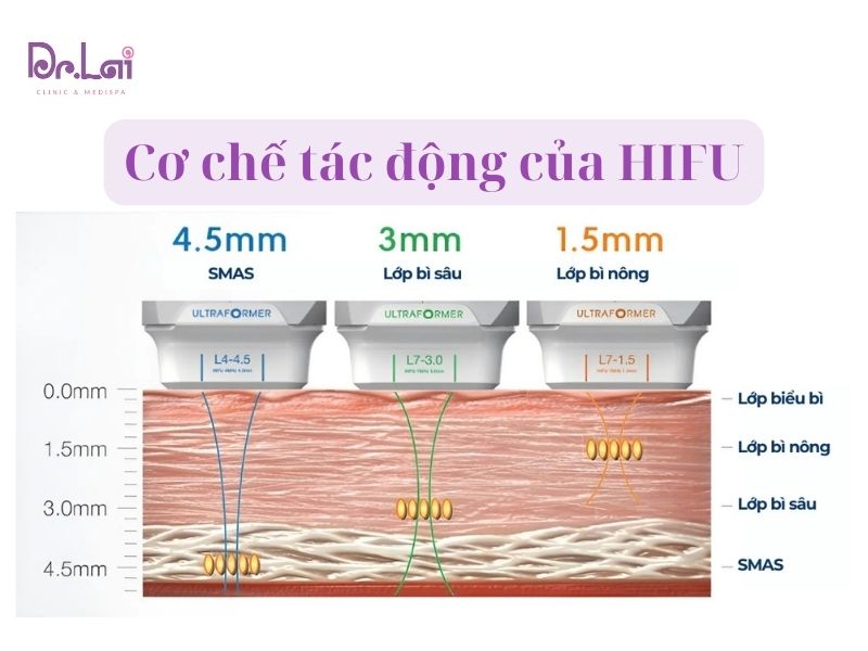 HIFU là gì và cơ chế hoạt động? 