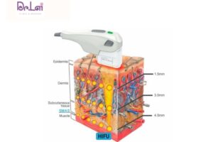 Tác dụng phụ của công nghệ Hifu bạn cần biết trước khi làm