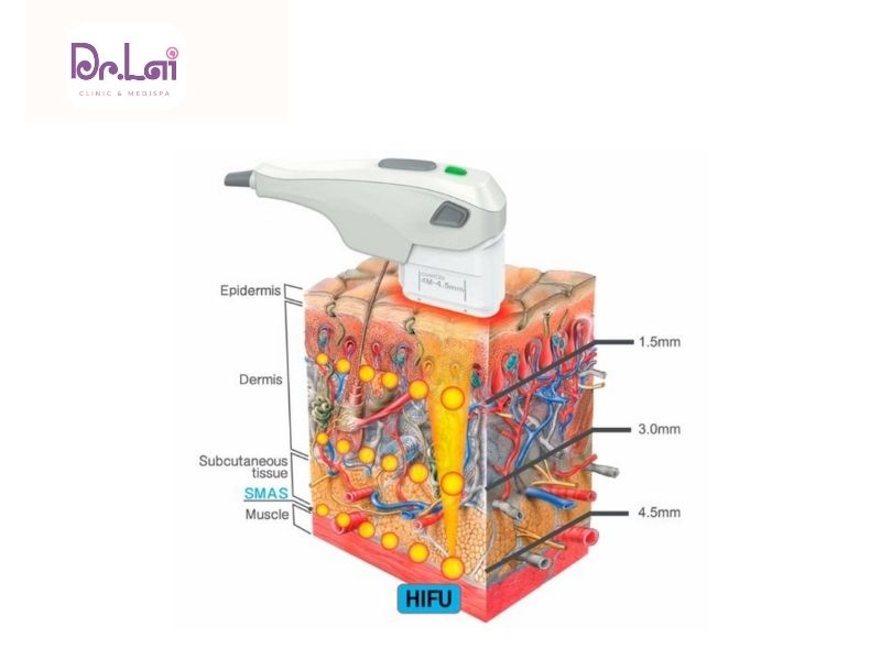 Những tác dụng phụ phổ biến của công nghệ Hifu