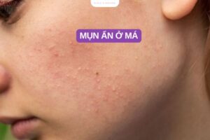 10 Cách chữa mụn ẩn ở má nhanh tại nhà ai cũng làm được
