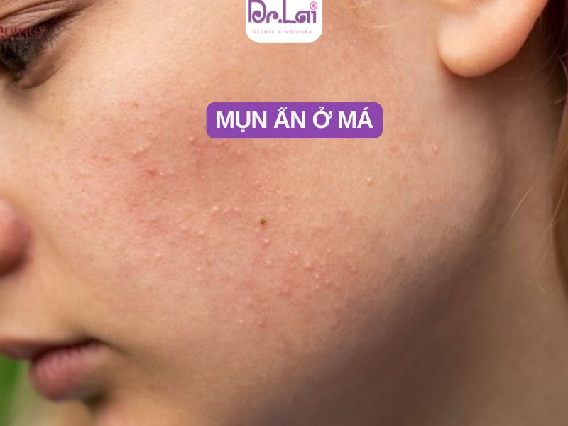 Mụn ẩn ở má: Nguyên nhân & dấu hiệu nhận biết