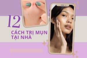 Cách chữa mụn trứng cá ở mặt tại nhà bằng nguyên liệu thiên nhiên