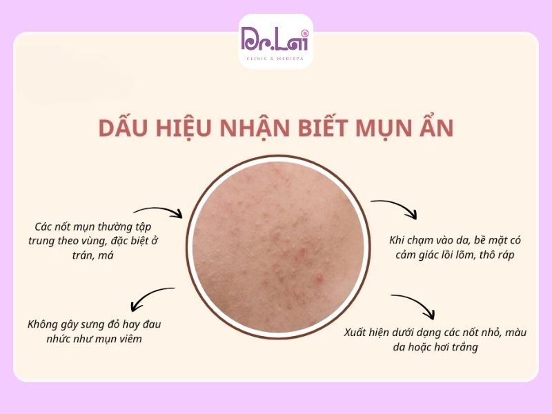 Cách nhận biết mụn ẩn trên da dễ nhất