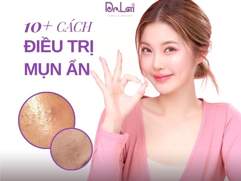 10+ cách trị mụn ẩn dưới da hiệu quả nhất