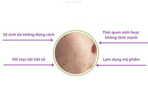 Nguyên nhân gây mụn ẩn và cách trị mụn ẩn da dầu hiệu quả