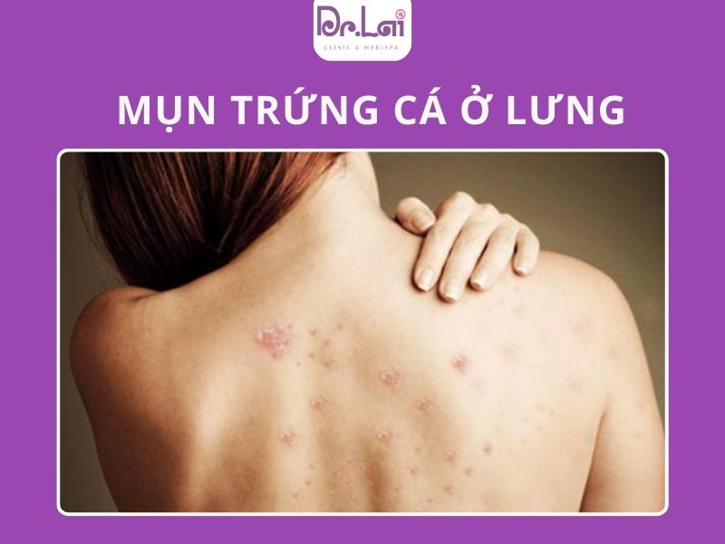 Nguyên nhân mọc mụn trứng cá ở lưng?