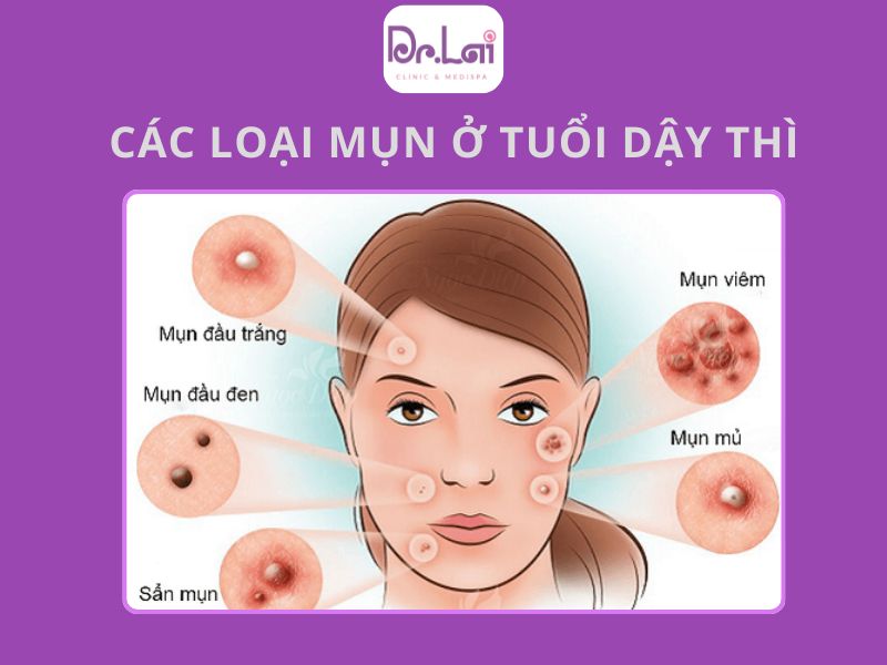 Mụn trứng cá tuổi dậy thì là gì?
