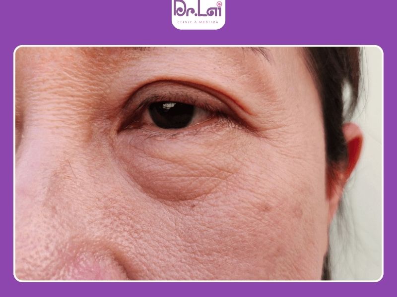 Vì sao da mặt bị chảy xệ và kém săn chắc?