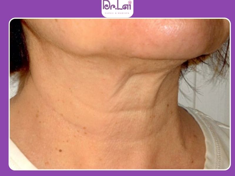 Căng da cổ không phẫu thuật có duy trì lâu không?