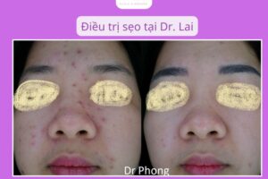 8 bước chăm sóc da sau khi cắt đáy sẹo để giảm thâm, giảm viêm