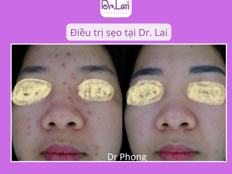 Lưu ý gì sau khi chăm sóc da khi cắt đáy sẹo?