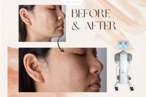 Công nghệ HIFU có tốt không so với tiêm filler, botox và laser?