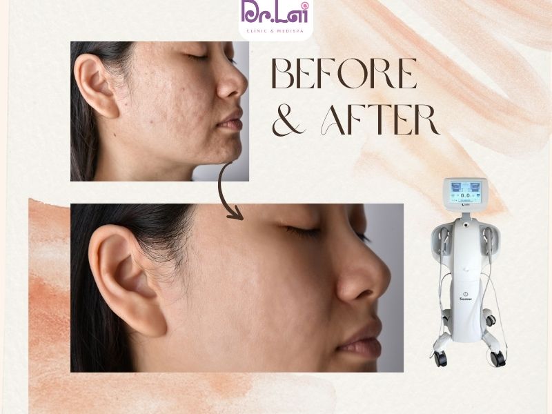 Công nghệ HIFU là gì?