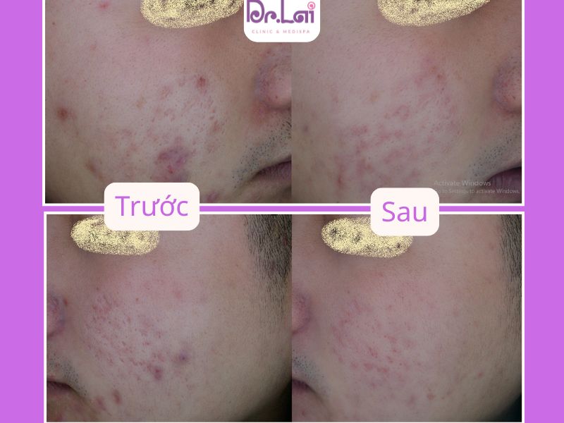 Quy trình thực hiện phi kim trị sẹo rỗ