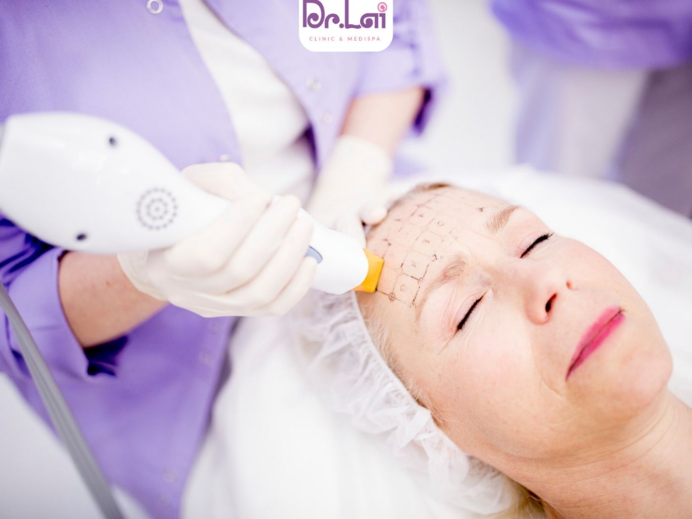 So sánh Thermage và Ultherapy khác nhau gì?