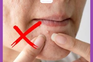 Cách trị mụn viêm đỏ không nhân tại nhà giúp giảm sưng nhanh chóng