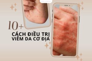 10+ Cách trị viêm da cơ địa dân gian giúp giảm ngứa nhanh tại nhà