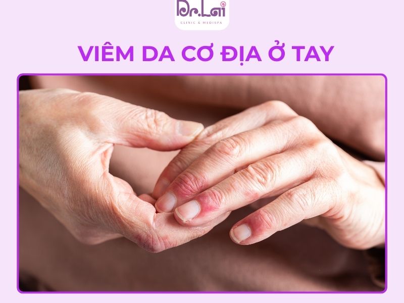 Viêm da cơ địa ở tay gây cảm giác ngứa ngáy, khóa chịu