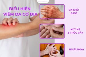 5 cách trị viêm da cơ địa ở tay hiệu quả, dễ áp dụng tại nhà