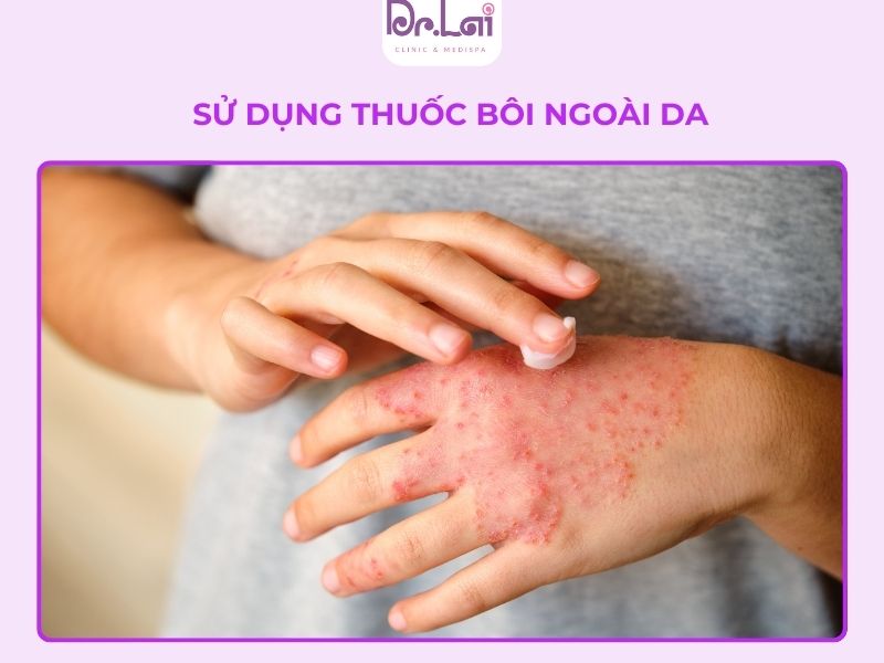 Dùng thuốc bôi là cách phổ biến và hiệu quả khi bị viêm da ở tay