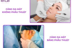 Căng da mặt có 2 phương pháp chính là phẫu thuật và không phẫu thuật
