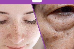 Cách phân biệt nám tàn nhang đồi mồi để điều trị đúng ngay từ đầu