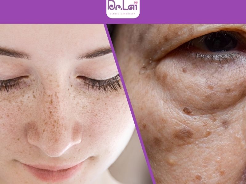 Phân biệt nám tàn nhang đồi mồi