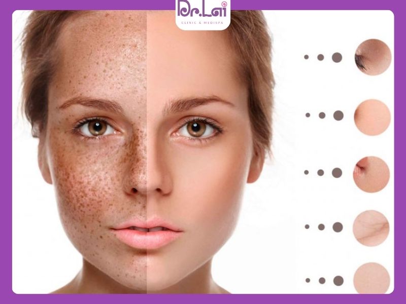 Tàn nhang thường nằm ở lớp thượng bì nên đáp ứng điều trị nhanh hơn nếu bảo vệ da tốt