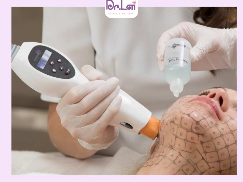 Thermage là công nghệ trẻ hóa da sử dụng sóng cao tần RF