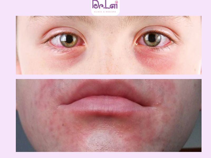 Da có dấu hiệu sưng đỏ