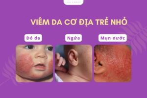Viêm da cơ địa ở trẻ nhỏ | Nguyên nhân, dấu hiệu và cách điều trị