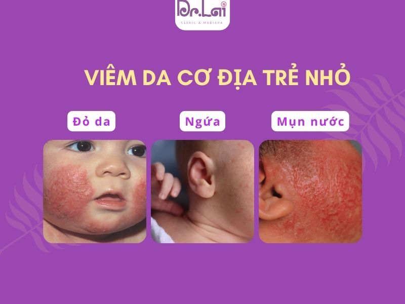 Dấu hiệu nhận biết viêm da cơ địa ở trẻ nhỏ