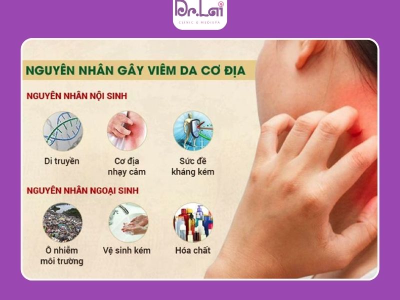 Nguyên nhân trẻ bị viêm da cơ địa