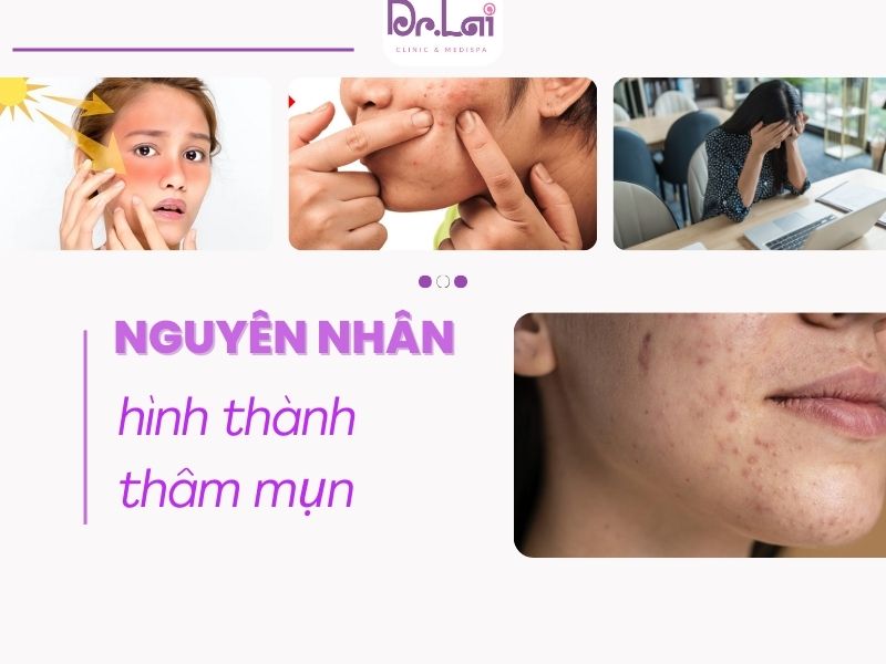 Nguyên nhân hình thành thâm mụn