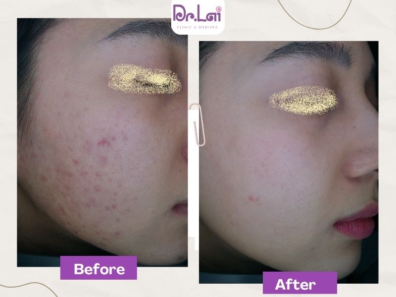 HÌnh ảnh mụn sau quá trình điều trị