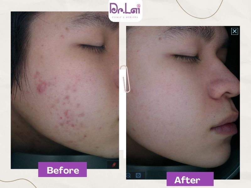 Giảm mụn, giảm thâm rõ rệt trên 2 má